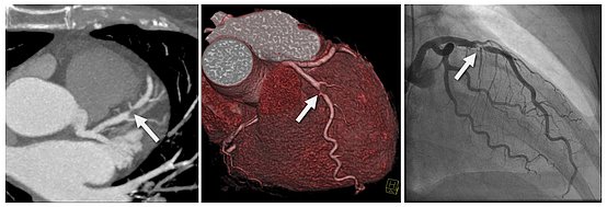 Darstellung einer Stenose (Engstelle) einer Herzkranzarterie