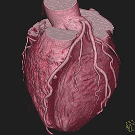 3-D Darstellung der Herzkranzarterien